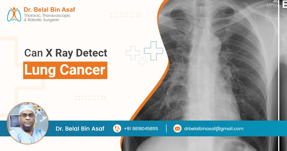 Can X-Ray Detect Lung Cancer