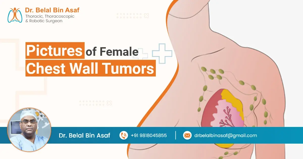 Pictures of Female Chest wall Tumors