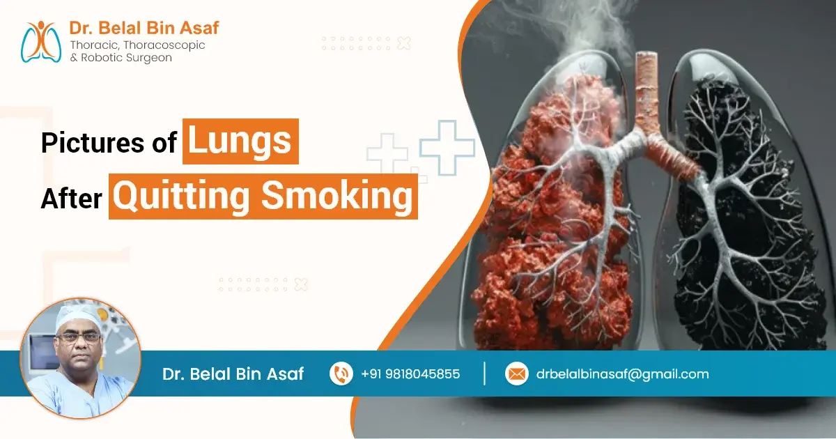 Images of Lungs After Quitting Smoking