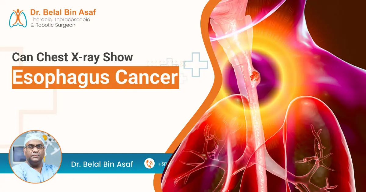 Can Chest X-ray Show Esophagus Cancer?