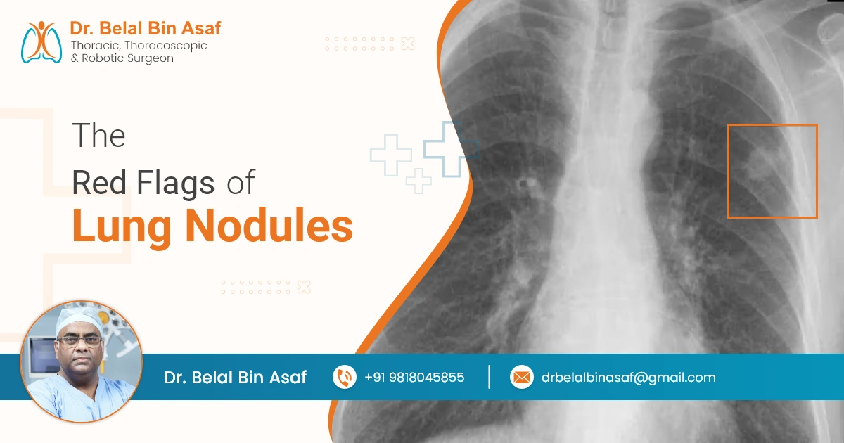 What are the Red Flags of Lung Nodules?