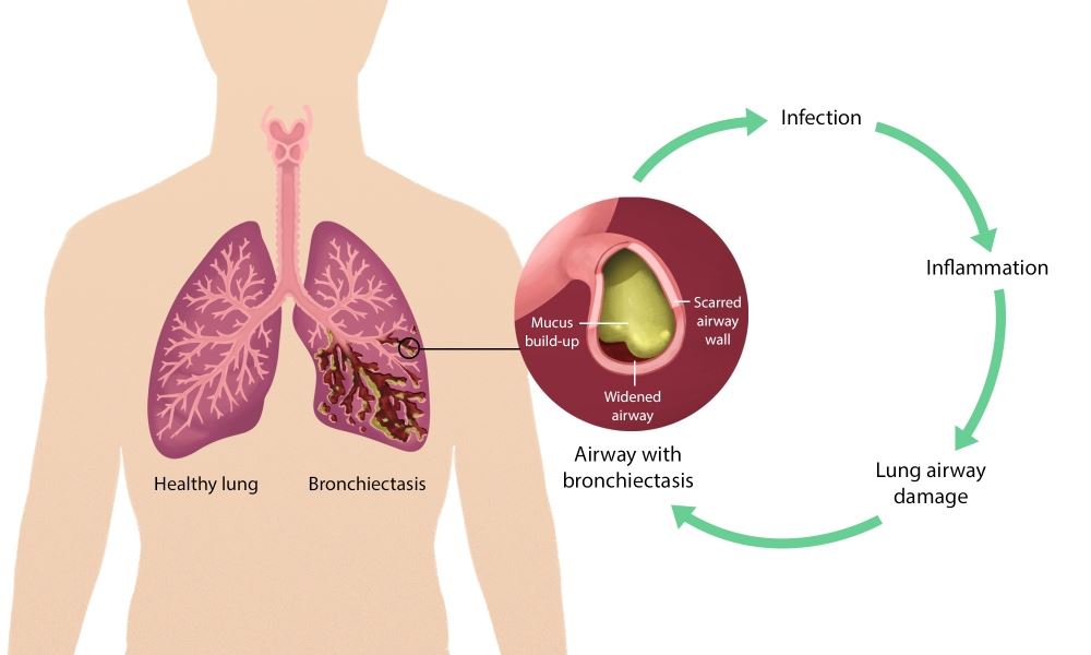 Best Lung Cancer Oncologist in India
