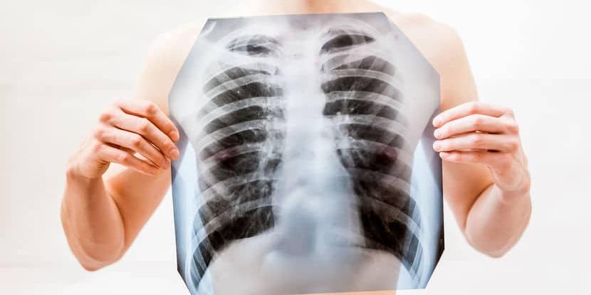 Best Doctor for Lung Cancer in Gurugram