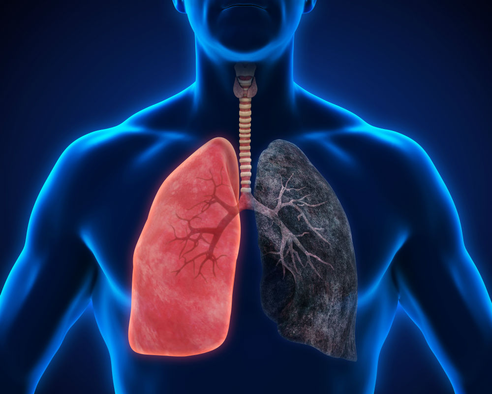 Best Lung Cancer Doctor in Noida
