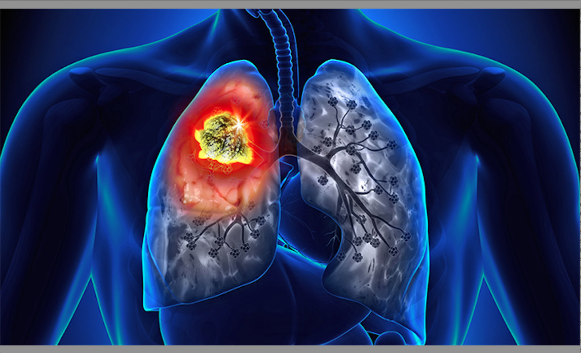 Lung Cancer Treatment Cost in Delhi