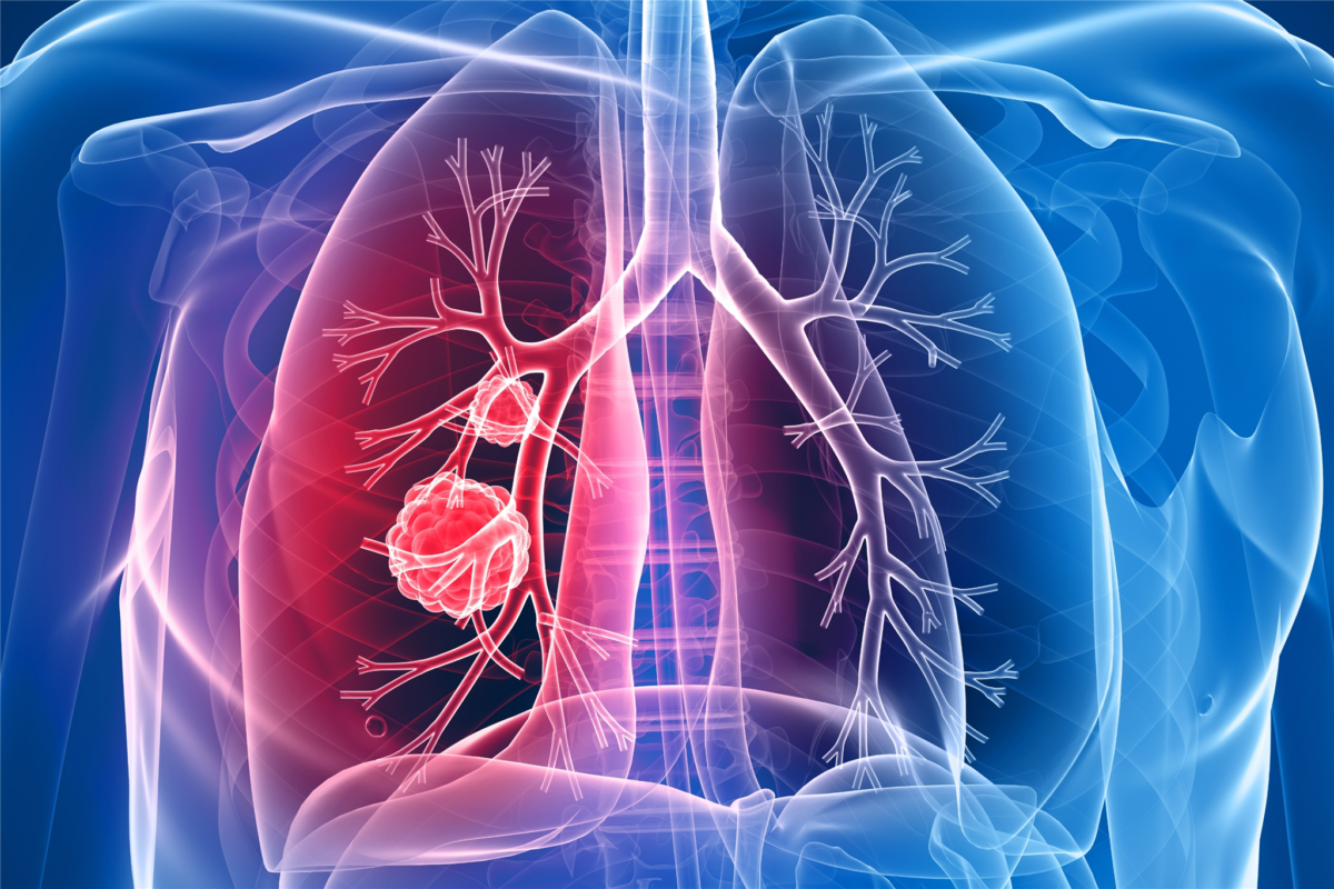 Lung Cancer Treatment Doctor