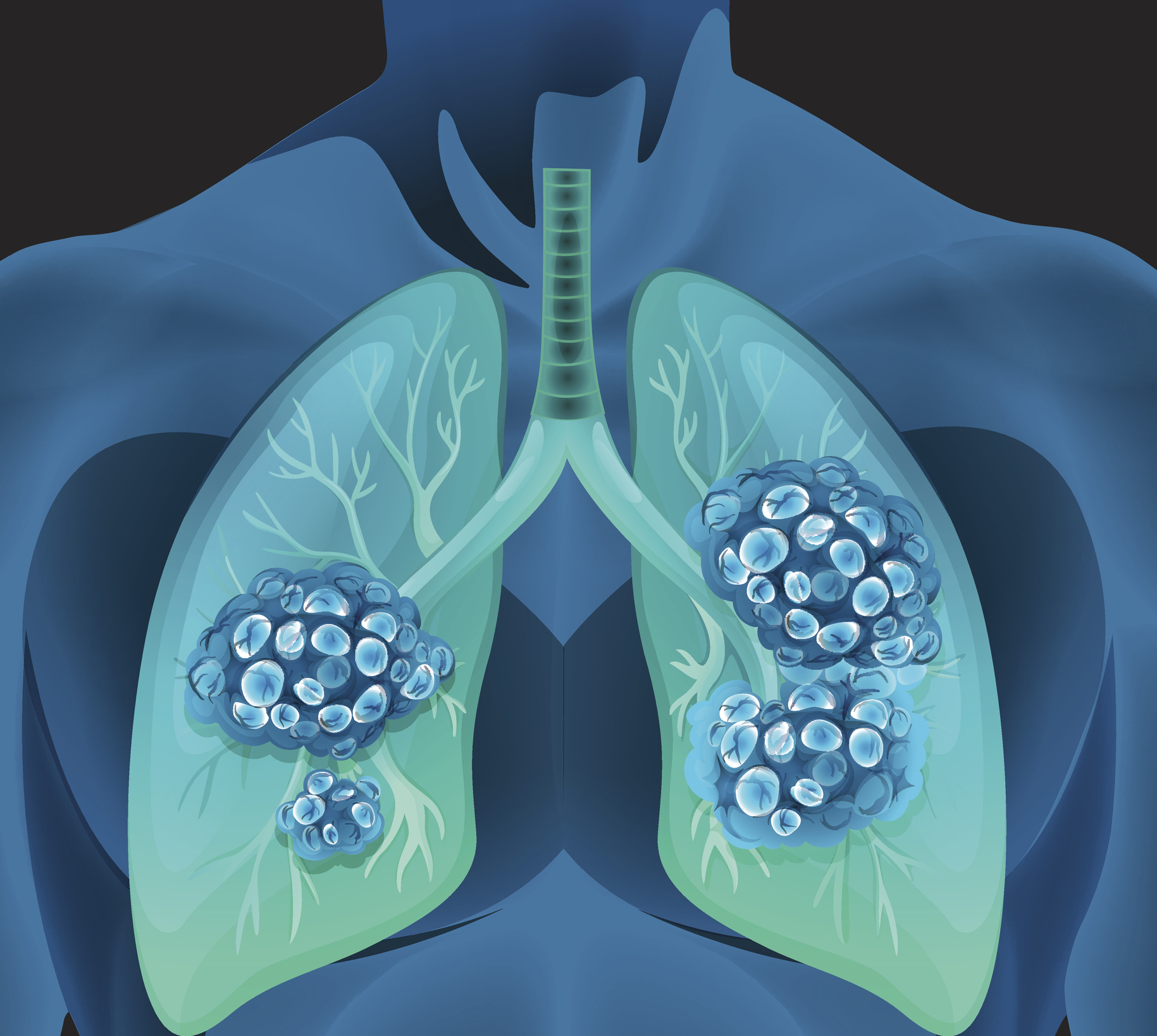 Best Lung Cancer Surgeon in India