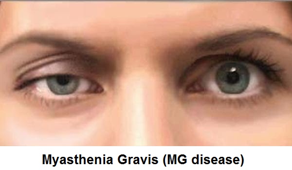 Myasthenia Gravis Treatment in Gurugram