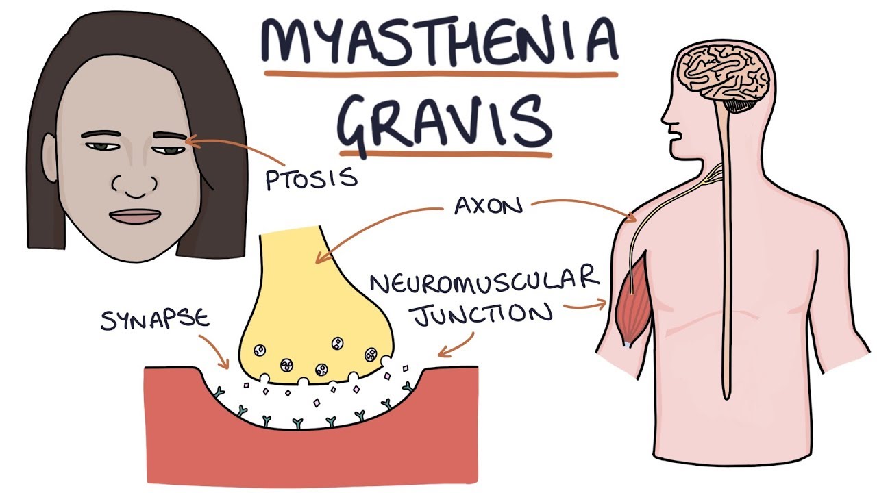 Best Surgeon for Myasthenia Gravis in Noida