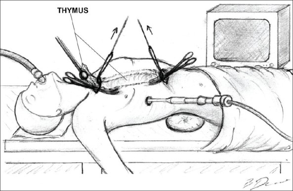 Robotic Surgeon for Thymectomy