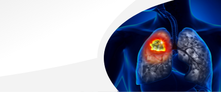 Lung Cancer Treatment in delhi