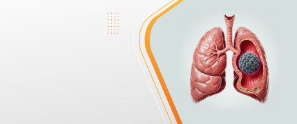 Aspergilloma Treatment in delhi
